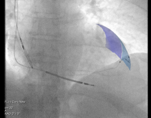 Front X-ray of patient’s heart with coloured area the target and three cardiac resynchronisation therapy pacemaker leads. The lead that loops up on the left hand side is the right atrial lead, which is next to the second in an L shape which is the right ventricular lead and the third with dots in the blue target area is the left ventricular lead.